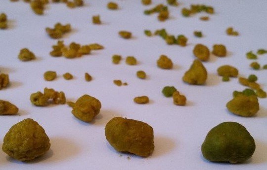 gallbladderliver Chronology Gallstones2