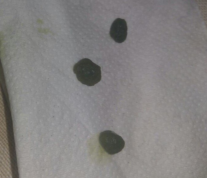 gallbladderliver chronology gallstones