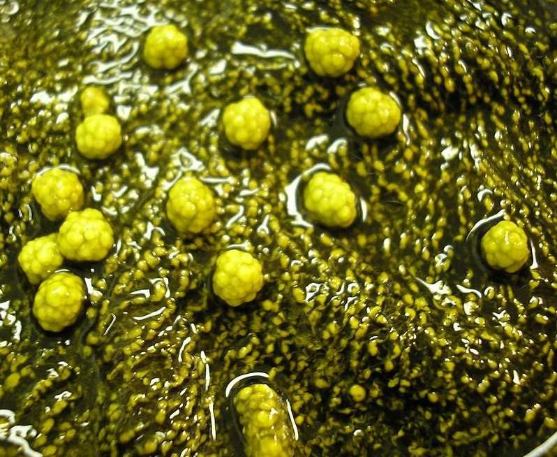 gallbladderliver Chronology gallbladder stones