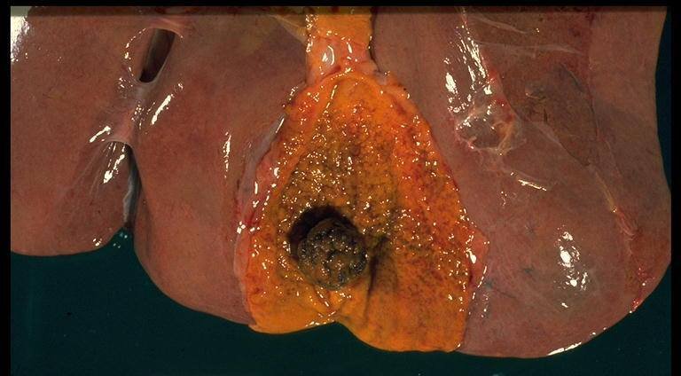 Read more about the article Hepatic – Intrahepatic Stones