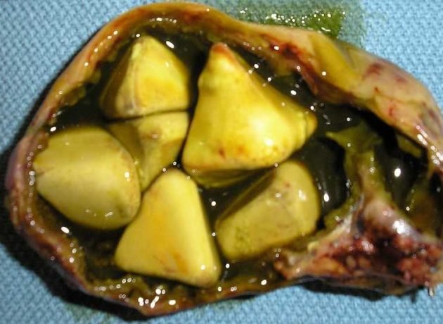 gallbladderliver Chronology removed gallbladder