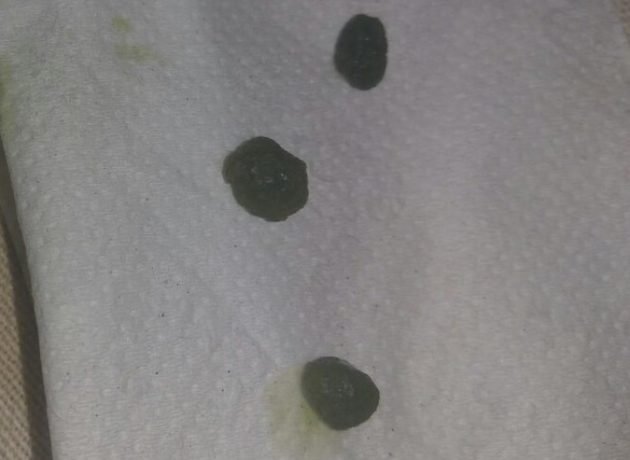 gallbladderliver chronology gallstones